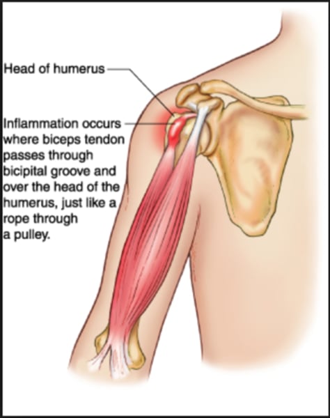 <p>What injury do you suspect for this patient? <br>- Patient is 32-year old male <br>- Plays pickleball 4 times per week <br>- Complains of right lateral elbow pain that is worse in the morning, better in the afternoon. Pain increases after playing pickleball. <br>- Reports pain is 4/10 at rest and 8/10 after playing. <br>- Pain is located on the right distal lateral humerus and extensor muscle belly <br><br>- sprain <br>- strain <br>- macrotrauma <br>- tendonitis</p>