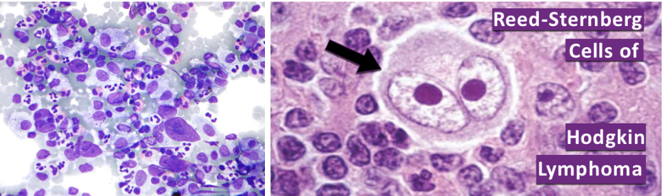 <p>HL är ett lymfom av germinala B-celler. Det är 10% av alla lymfom. Förekommer vid 15-35 års ålder eller senare i livet. Riskfaktorer är följande:</p><ul><li><p><strong>EBV infektion:</strong> Vanligt bland unga.</p></li><li><p><strong>HIV-pateinter</strong></p></li><li><p><strong>Organtransplantation</strong></p></li><li><p><strong>Artit</strong></p></li></ul><p>Vanliga symptom är B-symptom, klåda och förstorade lymfkörtlar.</p><p>Karaktäristiskt är <strong>Reed-Sternbergceller</strong>; dessa är B-celler som är CD15<sup>+</sup>, CD30<sup>+</sup> och CD45<sup>-</sup>. Saknar B-cellsmarkörer. Saknar uttryck av MHC-1 och mycket PD-1 → undviker immunförsvar. Attraherar eosinofiler och andra celler; plasmaceller, T-celler och eosinofiler.</p>
