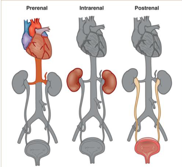 <p>sudden decline in renal function, <span>↓ in glomerular filtration with ↓ urine output →↑ retention of nitrogenous wastes, K+ and PO4-</span><br>– etiologies:<br>Pre-renal: disorder marked by ↓renal perfusion <br>Intra-renal: marked by poorly functioning renal tissue (<em>glomerular disease</em>)<br>Post-renal: marked by obstruction of uri tract (<em>kidney stones</em>)</p>