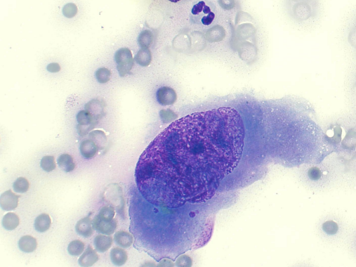 <p>Criteria of malignancy - Nucleoli</p><p>Describe the cell - malignant or no? Why?</p>