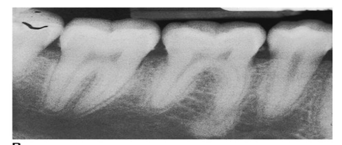 <p>This happens at the root apex sometimes. This is due to traumatic occlusal forces of a tooth on a microscopic view with dentin, cementum, and radicular pulp tissue noted in the root.</p>
