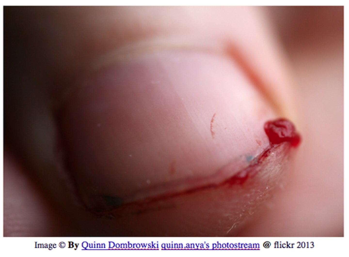 <p>blood clotting to stop bleeding by forming a physical barrier over a wound</p>