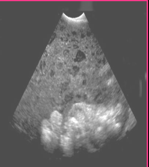 <p>Mucinous cystadenocarcinoma is likely to rupture causing _______ ________  and _________ ________</p>