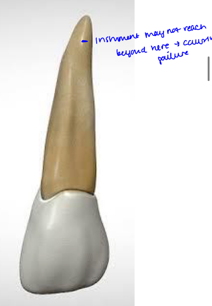 <p>Apical curvature in DP direction- files tend to straighten so don’t instrument apical third</p>