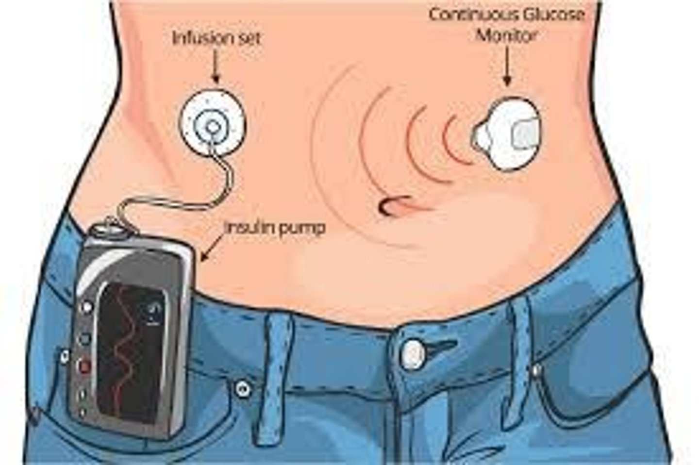 <p>Marked in units for accurate insulin dosing.</p>