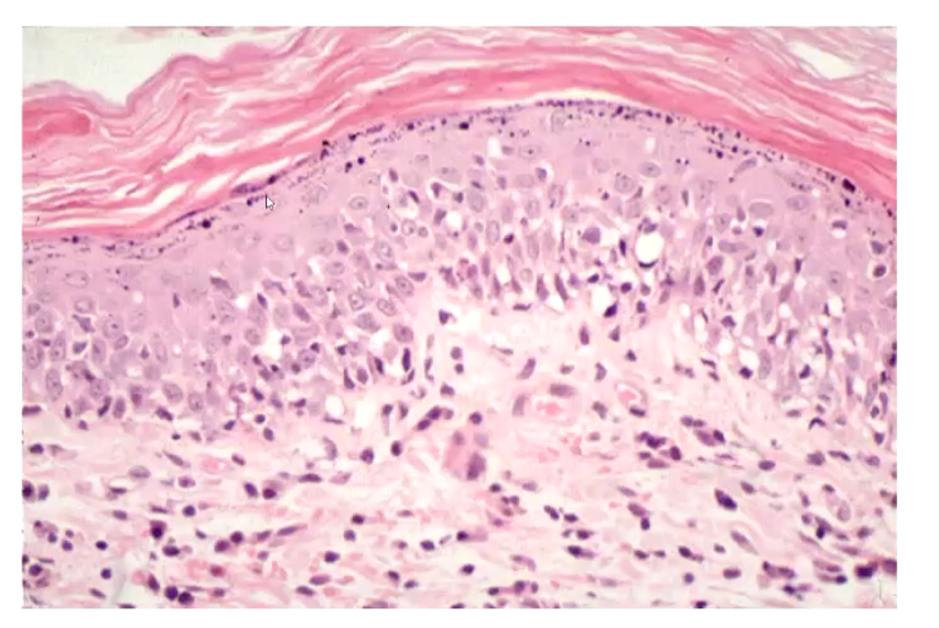 <p>Prominent granular layer associated with hyperkeratosis</p><ul><li><p>Lots of granules in stratum granulosum → suggests inflammation</p></li></ul><p></p>