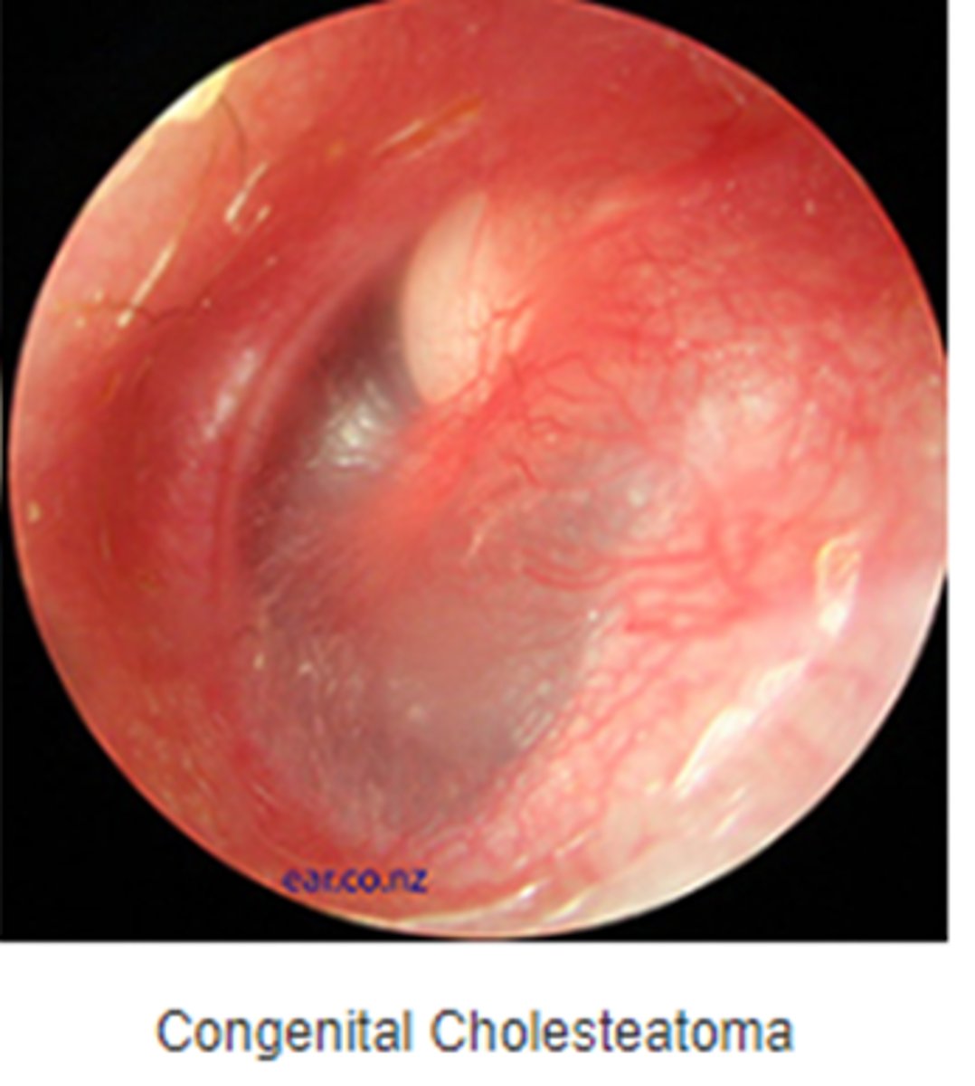 <p>Spherical white mass behind intact tympanic membrane</p>