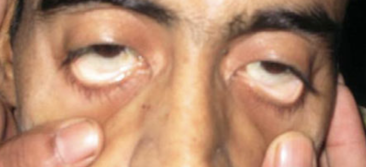 <p>Abnormal Skin Pigmentation Finding</p><ul><li><p>Seen in arterial insufficiency, decreased blood supply, and anemia</p></li><li><p>Vary from pale to ashen without underlying pink</p></li><li><p>Results from<strong> poor circulation</strong></p></li><li><p>Commonly seen on <strong>anemic patients </strong>dur to decreased hemoglobin and red blood cells</p></li></ul><p></p>