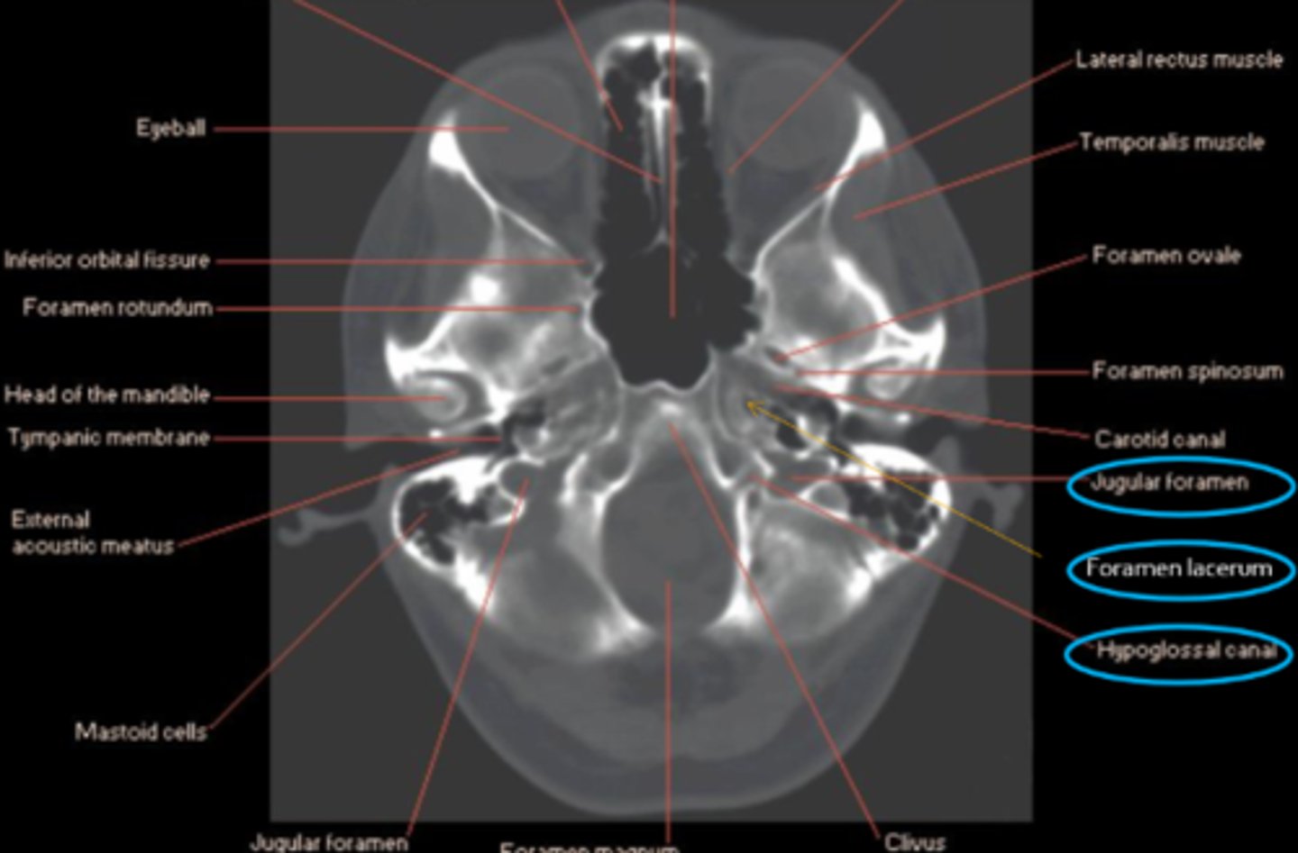 <p>jugular foramen = CN IX, X, XI</p><p>foramen lacerum = ICA, symp fibers</p><p>hypoglossal canal = CN XII</p>