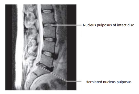 <p>The MRI of the vertebral column of the lumbar region above is in a ____ section showing a herniated disc</p>