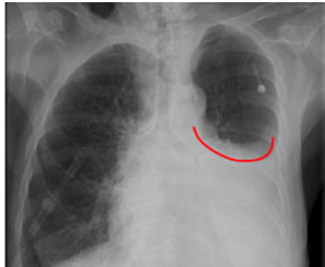 <ul><li><p><strong>Accumulation of fluid in pleural cavity</strong></p></li><li><p>collects in costophrenic angles</p></li><li><p>“<strong>Meniscus</strong> sign”</p></li><li><p>lateral lying x-ray</p></li></ul><p></p>