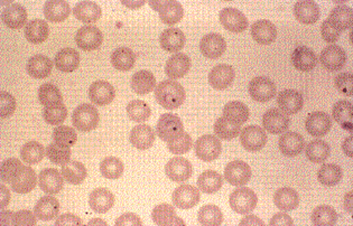 <p>d.P. vivax.</p><p>P. vivax has the widest geographic distribution and is the one most likely to be found in temperate climates. A fine pink stippling, known as Schüffner’s stippling, may be present in the cell. The young trophozoite of P. vivax is characterized by its ameboid appearance; by maturity, it usually fills the RBC, and golden brown malarial pigment is present.</p>
