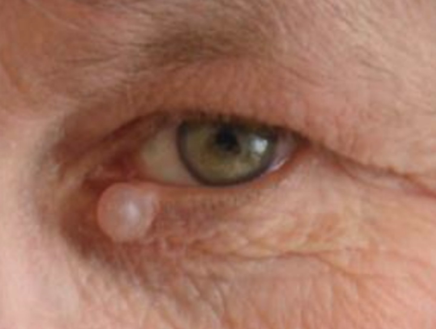 <p>blockage of Glands of Moll (eccrine/apocrine sweat glands) = superficial, translucent, firm dome-shaped of clear fluid</p>