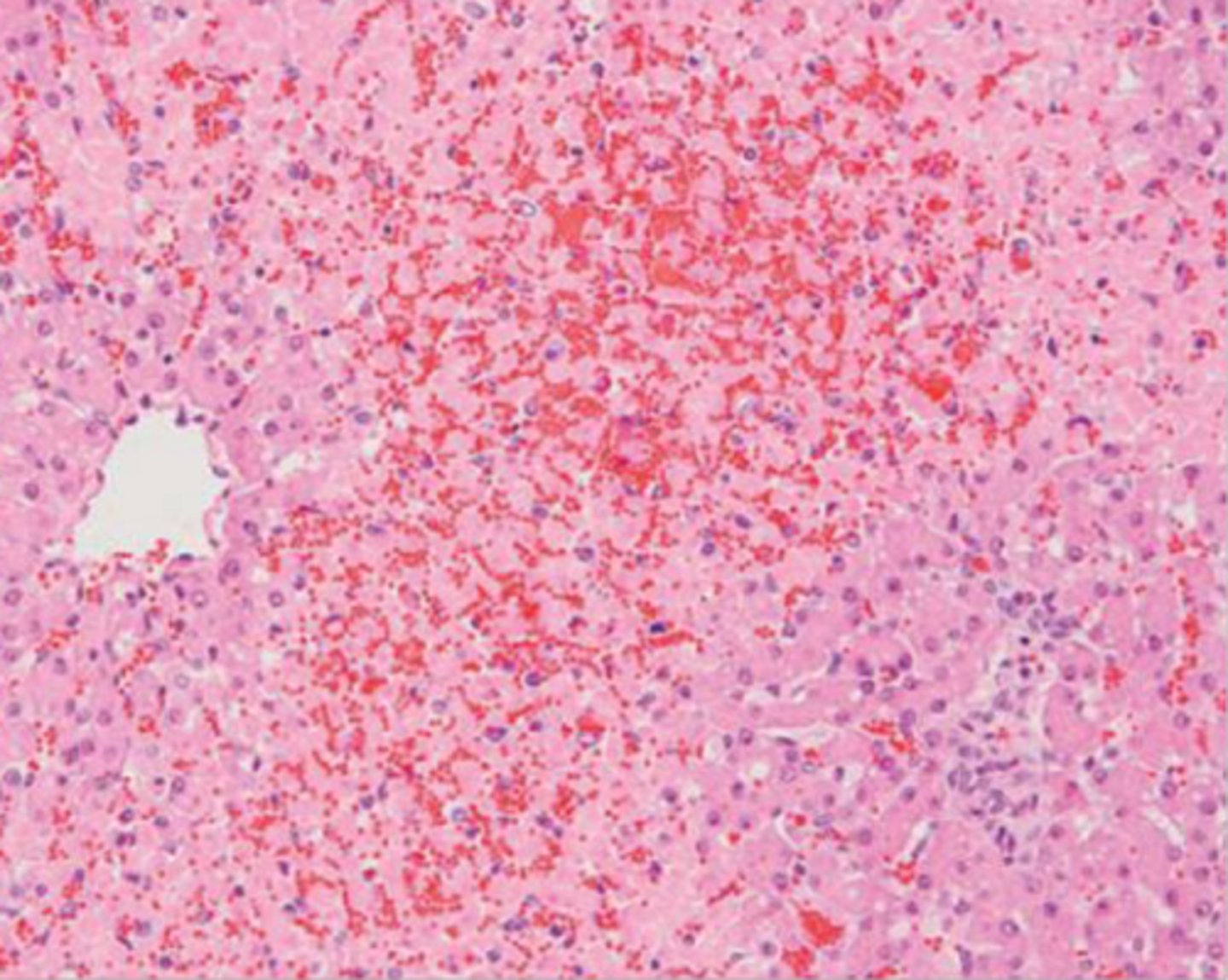 <p>Midzonal necrosis</p>