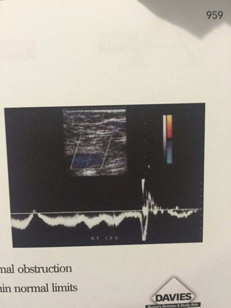 <p>480. (Peripheral arterial measurement techniques)</p><p>Your patient is a 30 year old female with a four day history of calf pain and swelling. This duplex image documents which of the following flow characteristics?</p><p>a. pulsatile flow consistent with tricuspid regurgitation</p><p>b. venous reflux, suggestive of incompetent valves</p><p>c. continuous flow, which implies a proximal obstruction</p><p>d. spontaneous, phasic flow, which is within normal limits</p>
