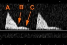 <ol><li><p>Based on this waveform, what can be assumed about what type of patient this is? This is a Doppler of the uterine artery. </p></li><li><p>What is seen at letters ‘B’ and ‘C’?</p></li></ol><p></p>