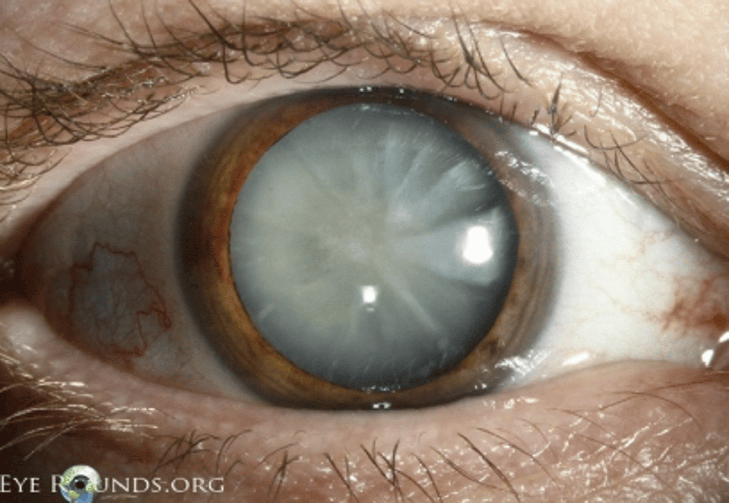 <p><u>Etio</u>: <strong>common &gt;60 yo, leading causes of blindness</strong></p><p><u>Risk factors</u>: <strong>aging, DM, steroid use</strong>, statin use, sunlight, <strong>smoking</strong></p><p><u>S&amp;S</u>: gradually progressive blurred vision, no pain/redness, usually bilateral, <strong>lens opacification (thickening)</strong>, glare with lights</p><p><u>Testing:</u> Early: dilated eye exam w/ ophthalmoscope, Late: no red reflex and white pupil</p><p><u>Tx</u>: surgery, annual eye exam, stop smoking, control DM, check HLD regularly</p>