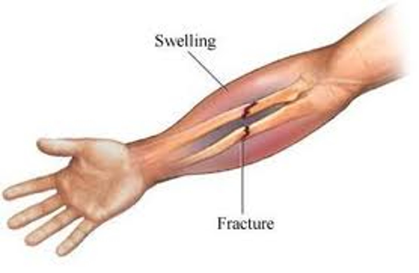 <p>type of fracture where the bone does not penetrate the skin; also called closed</p>