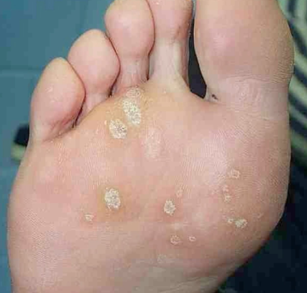 <p>Viral warts on the sole; painful; appear as dark spots under a callus</p>