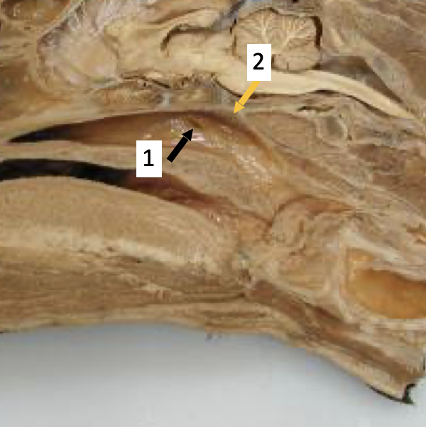 <ol><li><p><span>Openings of the </span><strong><span>Auditory tubes</span></strong></p></li></ol><ul><li><p><span>Lead to Tympanic bulla or middle ear&nbsp;</span></p></li><li><p><span>Lined by respiratory epithelium- infection</span></p></li><li><p><span>Function -equalisation of pressure</span></p></li></ul><p></p><ol start="2"><li><p><strong><span>The Pharyngeal tonsil:</span></strong></p></li></ol><ul><li><p><span>Part of </span><strong><span>retro-pharyngeal</span></strong><span> lymph centre</span></p></li><li><p><span>Lymphatic tissue- immuno surveillance</span></p></li></ul><p></p>