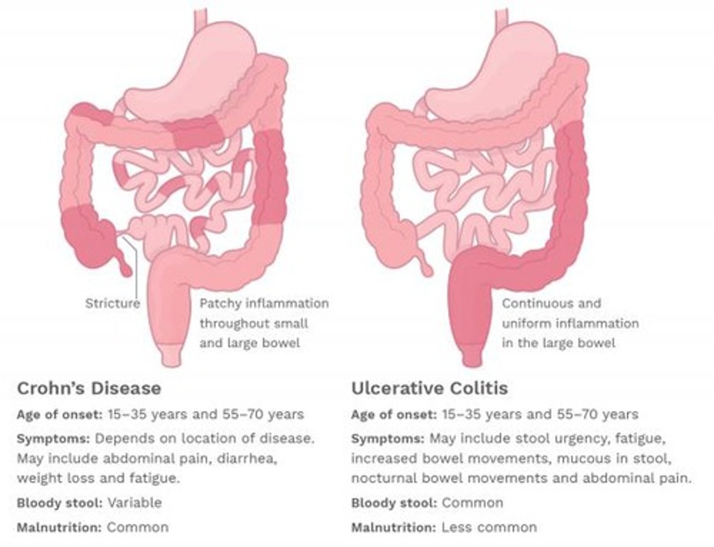 <p>A group of disorders, including Crohn's disease and ulcerative colitis, characterized by chronic inflammation of the gastrointestinal tract.</p>