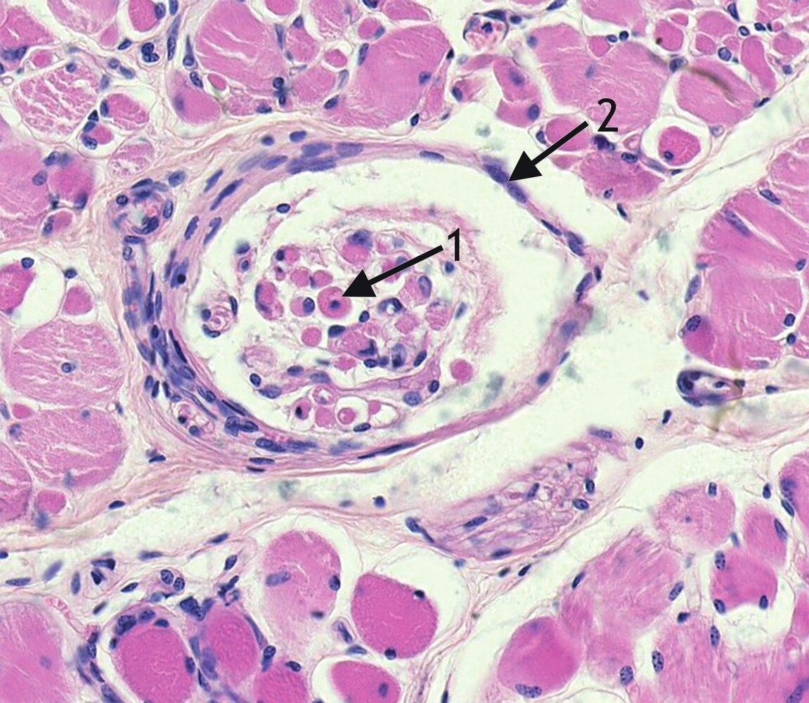 <p>17. Which statement about the histological image is correct?</p><p>A. Arrow 1 points to an oocyte.</p><p>B. Arrow 1 points to an intrafusal muscle fiber.</p><p>C. Arrow 1 points to a pseudounipolar ganglion cell.</p><p>D. Arrow 2 points to the urinary pole of the Bowman’s capsule.</p><p>E. Arrow 2 points to the perineurial sheath of a nerve.</p>