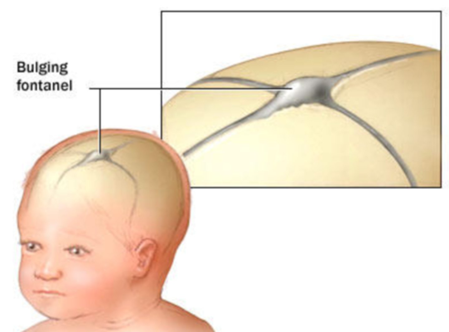 <p>- bulging fontanelle (if not yet fused)</p><p>- apnea</p><p>- purpuric rash</p><p>- irritability</p><p>- refusal to eat</p><p>- convulsions</p>