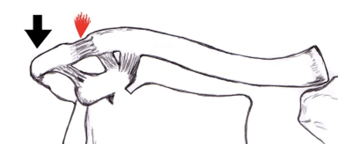 <p>AC ligament stretched --> bursa inflammation, AC laxity, pain</p>