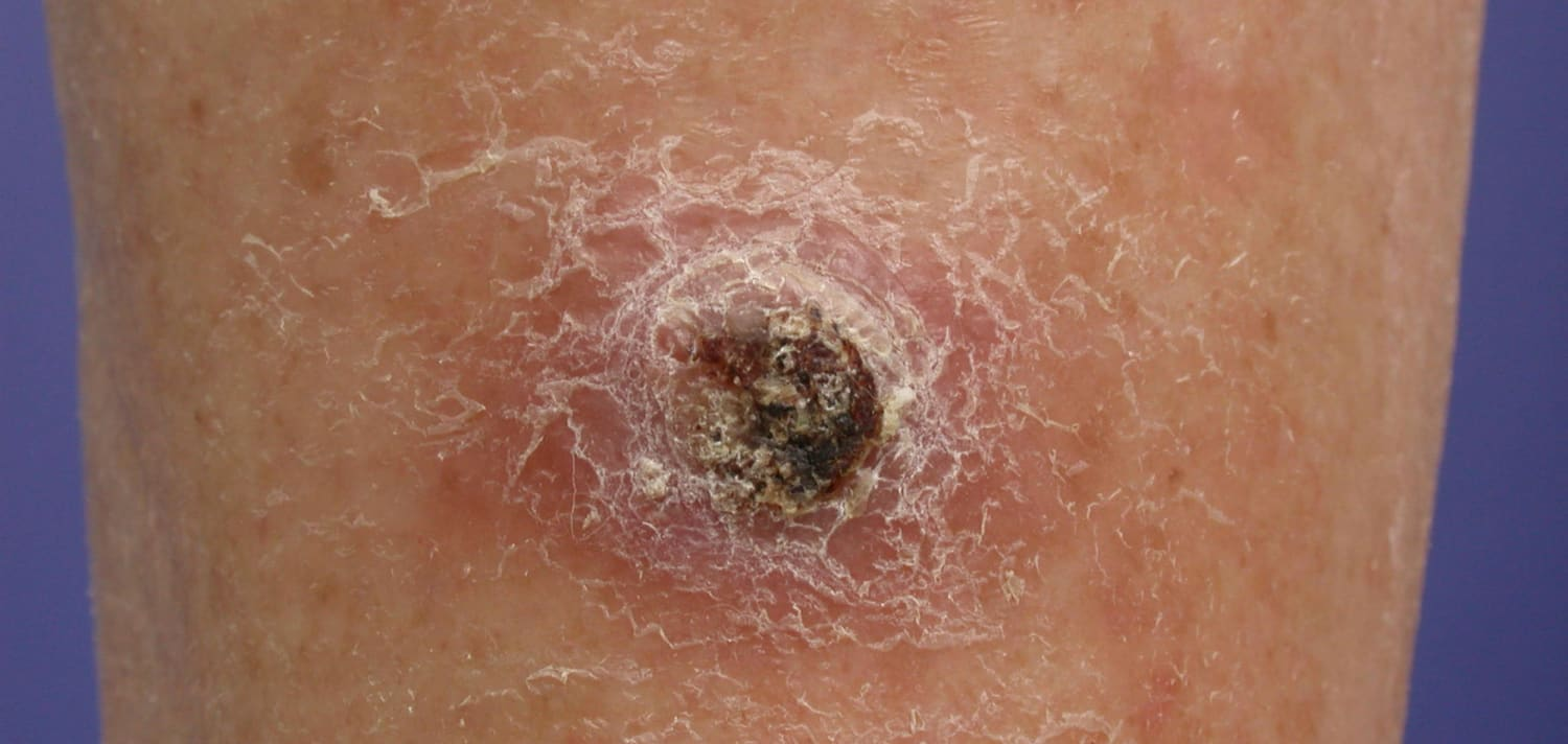 <p>A type of skin cancer that arises from squamous cells in the epidermis, often appearing as a firm, red nodule or a flat sore that bleeds or crusts</p>