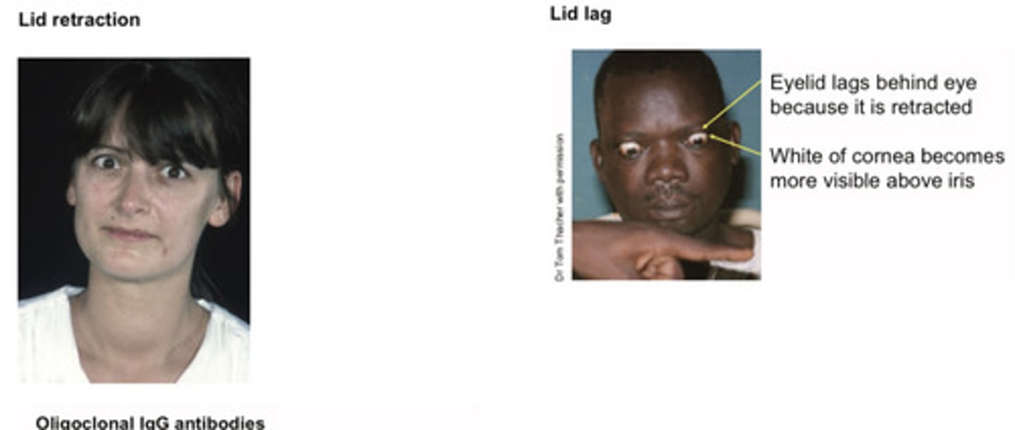 <p>Goitre</p><p>Eye signs (lid retraction + lid lag)</p><p>Thryotoxicosis</p>