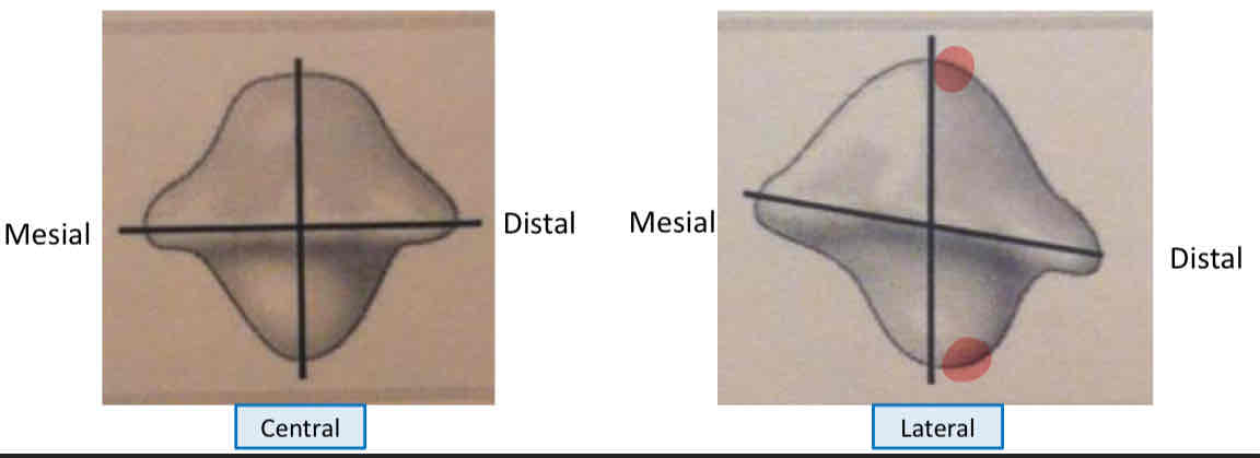 <p>how to distinguish between mandibular central and lateral incisor </p>