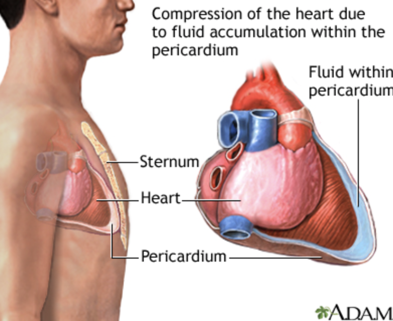 <p><strong>Pericardiocentesis:</strong></p><ul><li><p>Removes fluid to restore CO</p></li><li><p>Position: HOB 45–60°</p></li><li><p>Monitor VS, SpO₂, ECG, hemodynamics</p></li><li><p>Ultrasound-guided needle insertion</p></li><li><p>Post-procedure: monitor rhythm, BP, CVP, heart sounds</p></li><li><p><strong>Complications:</strong> arrhythmias, coronary/ventricular puncture, pleural laceration</p></li></ul><p><strong>Pericardiotomy (Pericardial Window):</strong></p><ul><li><p>For recurrent effusions (e.g., neoplastic disease)</p></li><li><p>Creates an opening for continuous drainage into the mediastinum</p></li></ul><p></p>
