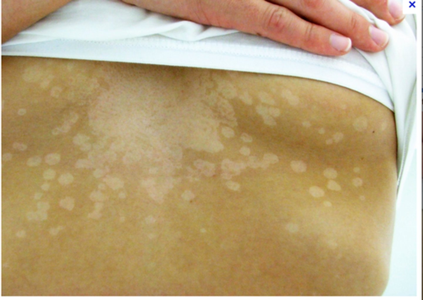 <p>fungal infection of skin caused by yeast, treated with topical selenium sulfide, topical antifungals; flat to slightly elevated brown papules and palques that scale when they are rubbed along with areas of hypopigmentation; puritis; most commonly found on trunk and shoulders</p>