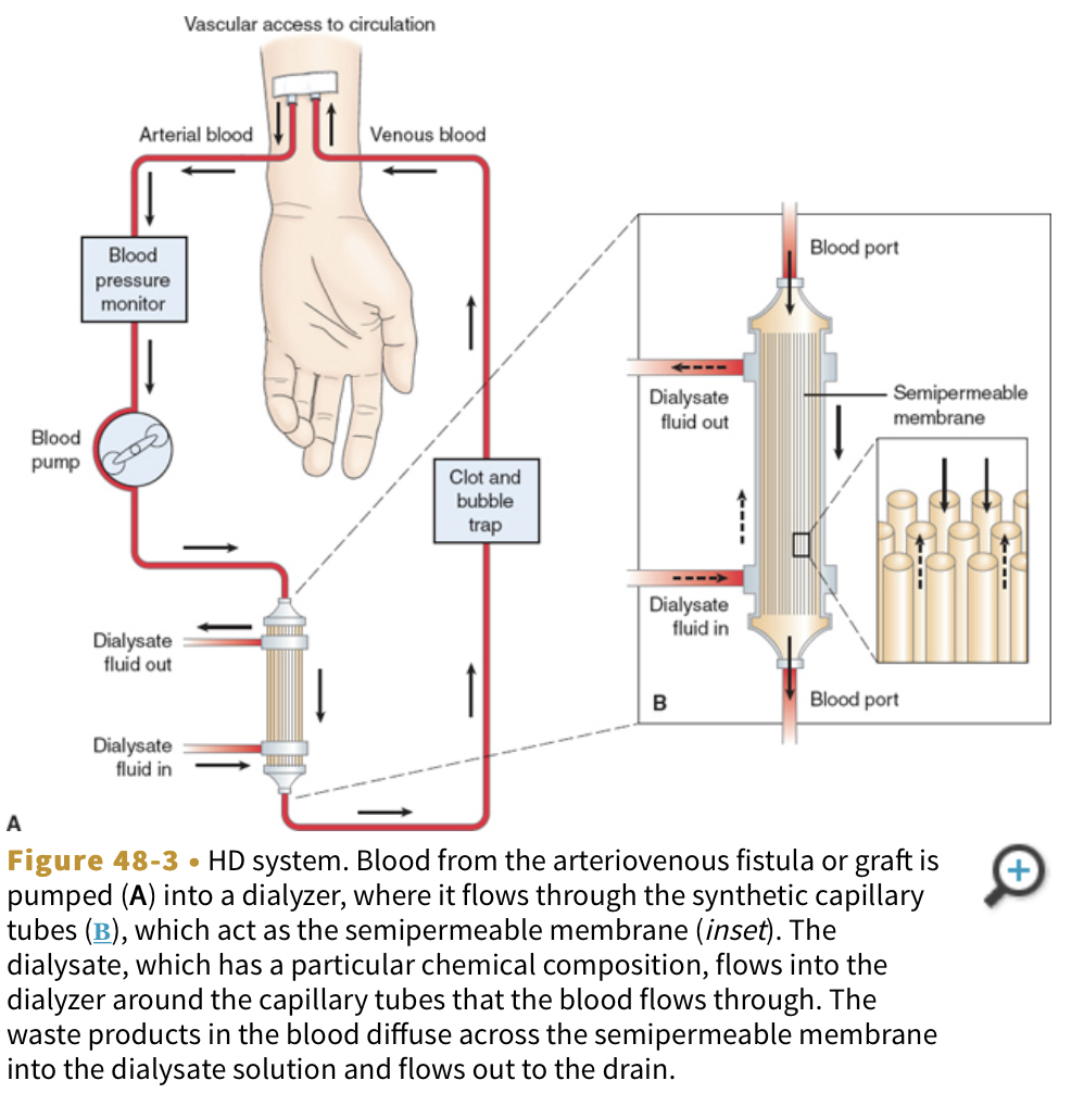 <p>procedure that circulatess the patient’s blood through a machine to remove waste products and excess fluid</p>