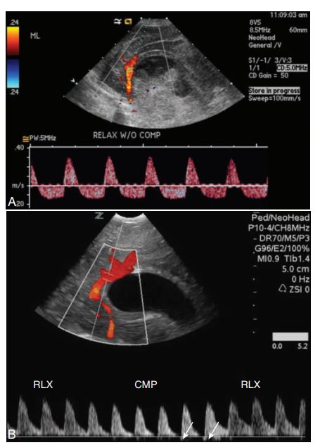<p> Spectral Doppler of the pericallosal artery in the presence of hydrocephaly to evaluate for intracranial pressure (ICP). (A) Neonate with bilateral grade IV hemorrhage and a diffusely echogenic and swollen brain demonstrates reversal of diastolic flow without compression, indicating elevated ICP.</p><p></p><p> (B) Premature infant with bilateral periventricular leukomalacia shows an absence of diastolic flow with compression on the anterior fontanel. The small bit of reversal of flow shown with arrows indicates ICP is increasing. CMP, With transducer compression; RLX, with relaxation.</p>