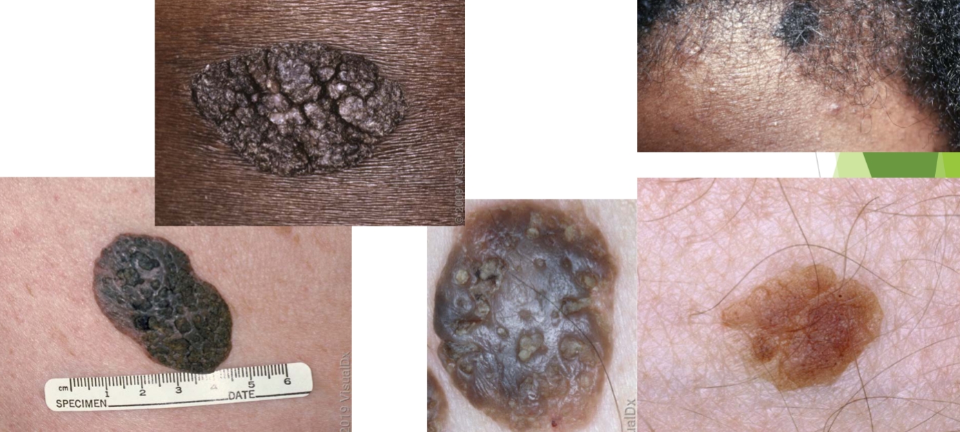 <p>seborrheic keratosis (SK) characteristics</p>