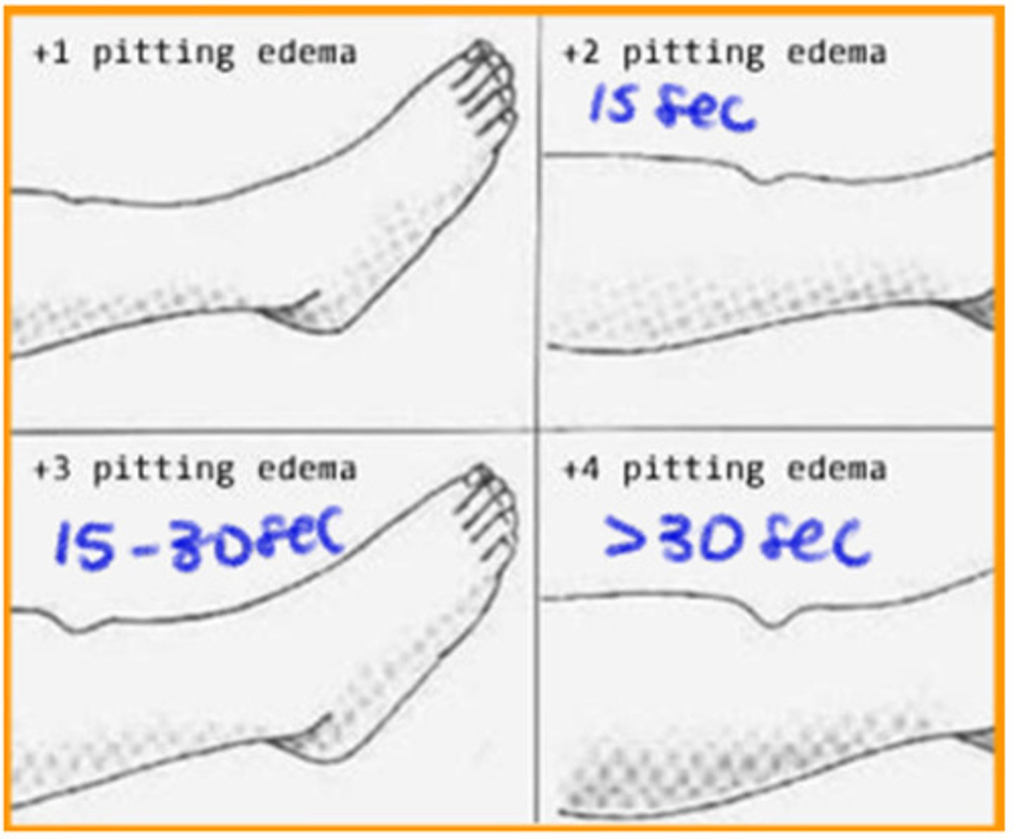 <p>helps determine severity along with asymmetry in the limbs</p><p>-pitting edema: short duration edema (can be timed to see how long it takes to go back to normal)= finger indentation of the skin</p><p>-brawny edema: tissue feels hard upon palpation, indicates fibrotic changes</p><p>-weeping: fluid leaks, wound healing is impaired; occurs mostly in the LE</p>