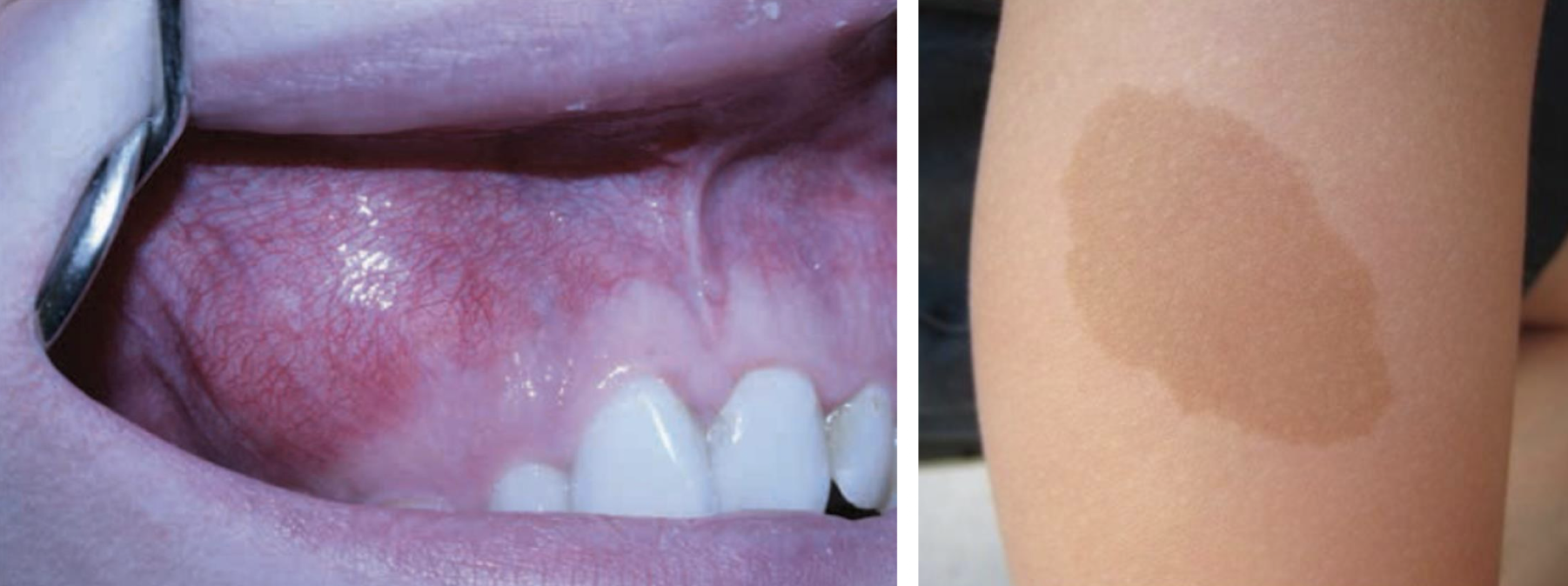 <p>fibrous dysplasia affecting maxilla</p>