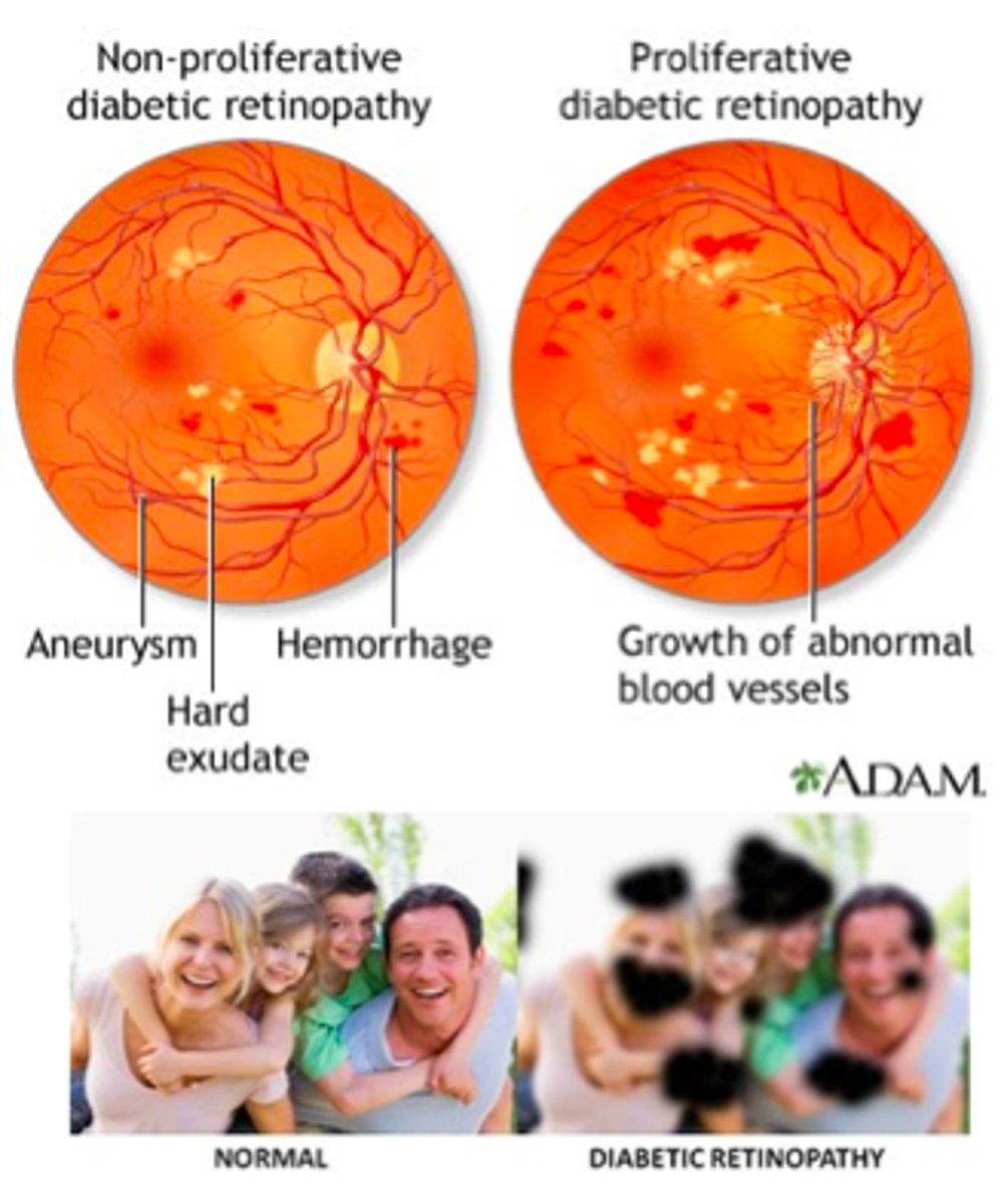 <p>non-proliferative</p><p>proliferative</p>