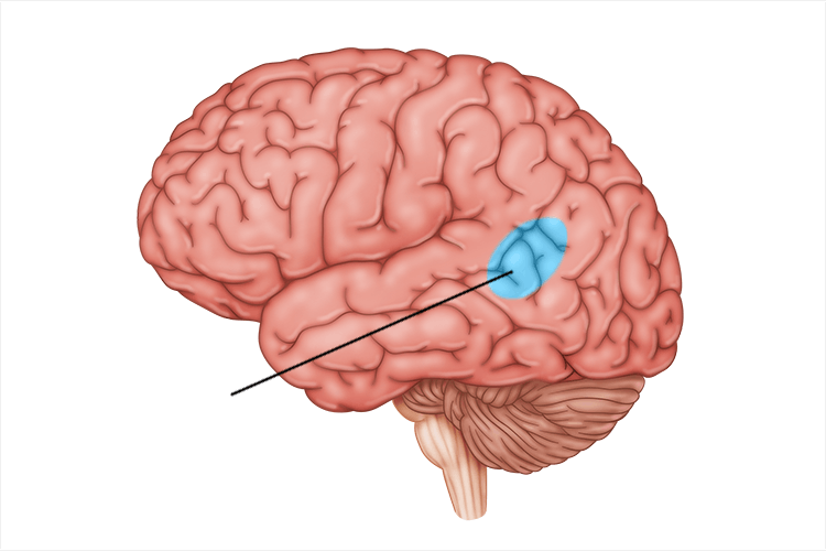 <p><strong>language comprehension</strong>; only in left hemisphere</p>