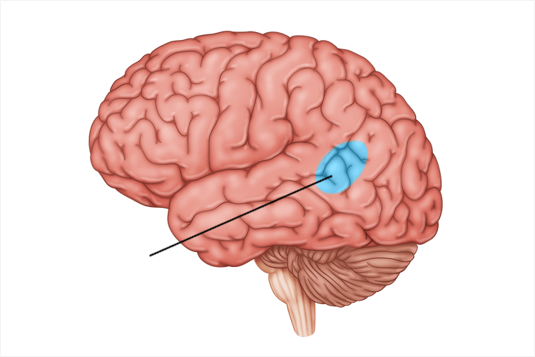 <p>language comprehension; only in left hemisphere</p>