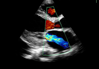 <p>The Anterior Mitral Leaflet (AML) on the top and the Posterior Mitral Leaflet (PML) on the bottom.</p>
