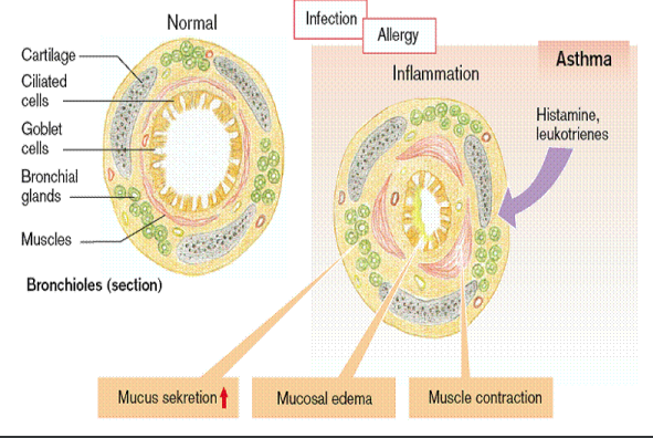 <ul><li><p>External pressure from enlarged thyroid gland other masses</p></li></ul><ul><li><p>Physical obstruction of bronchial lumen</p><ul><li><p>fx.: tumours, inhaled foreign bodies</p></li></ul></li><li><p>Narrowing of airways from smooth muscle spasm or inflammation</p><ul><li><p>fx.: asthma</p></li></ul></li></ul><p></p>