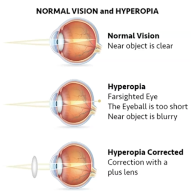 <p>What happens to eyeball when hyperopia occurs?</p>