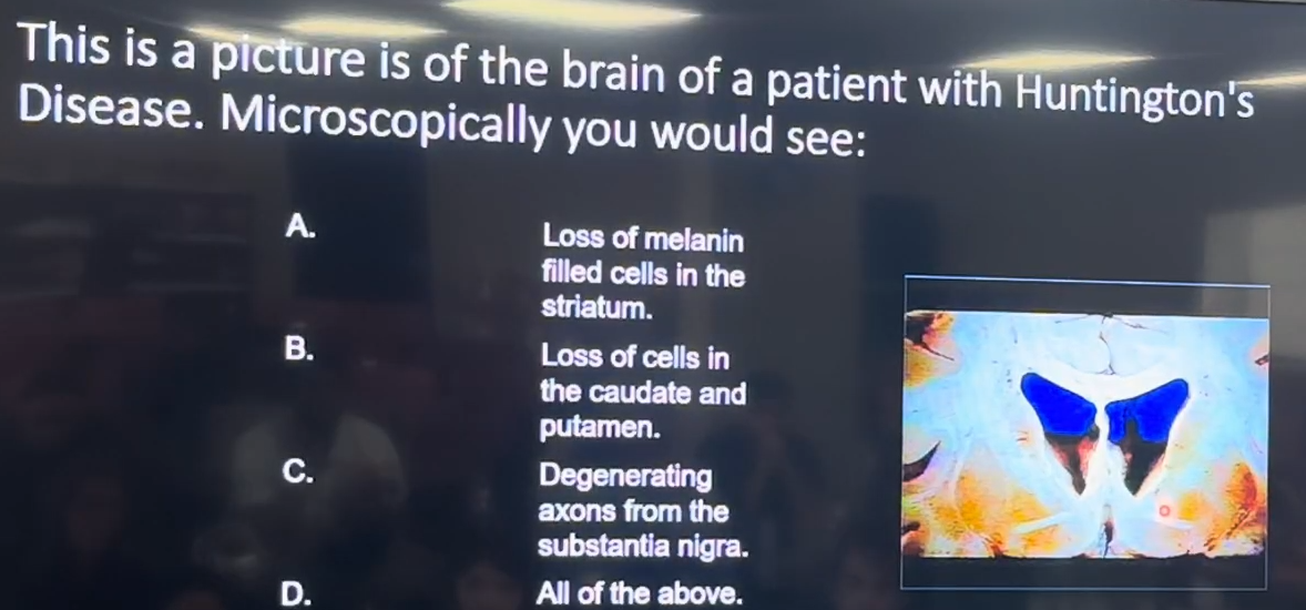 <p>This is a picture of a patient with Huntington’s Disease. Microscopically you would see:<br><br>A. Loss of melanin filled cells in the striatum<br>B. Loss of cells in the caudate and putamen<br>C. Degenerating axons from the substantia nigra<br>D. All of the above</p>