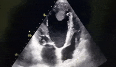 <p><span><span>What cardiac condition is demonstrated in this image?</span></span></p><p>LA thrombus</p><p>Metastatic tumor</p><p>LV myxoma</p><p>Rhabdomyosarcoma</p><p>LV Apical thrombus</p>