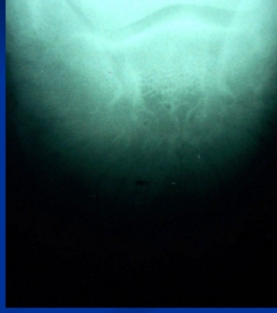 <ul><li><p><span style="background-color: transparent;"><strong><span>Et: </span></strong><span>Repeated </span></span><span style="background-color: transparent; color: red;"><span>bruising</span></span><span style="background-color: transparent;"><u><span>, thin-soled, laminitic</span></u><span> horses</span></span></p></li><li><p><span style="background-color: transparent;"><strong><span>Cs:</span></strong><span> </span><strong><span>Chronic</span></strong></span><span style="background-color: transparent; color: red;"><strong><span> bilateral forefoot lameness,</span></strong></span><span style="background-color: transparent;"><strong><span> </span><u><span>choppy gait</span></u></strong><span>, digital pulse, soreness, heat</span></span></p></li><li><p><span style="background-color: transparent;"><strong><span>Dt:</span></strong><span> Rads with </span></span><span style="background-color: transparent; color: red;"><strong><span>demineralized P3 solar margin</span></strong></span></p></li><li><p><span style="background-color: transparent; color: red;"><strong><u><span>Septic</span></u><span>: extension of sole abscess or direct injury </span></strong></span></p></li><li><p><span style="background-color: transparent;"><strong><span>Tx:</span></strong><span> Rest, Bute, </span></span><span style="background-color: transparent; color: red;"><span>pads,</span></span><span style="background-color: transparent;"><span> curettage + </span><u><span>antibiotics + sx debridement (septic)</span></u></span></p></li></ul><p></p>