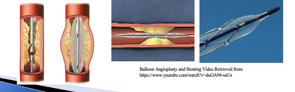 <p>PTCA- Angioplasty balloon, stent insertion or drug eluting stents </p><p>These are used to treat stenosis from atherosclerosis (vessel plaque) in the heart and other areas </p>