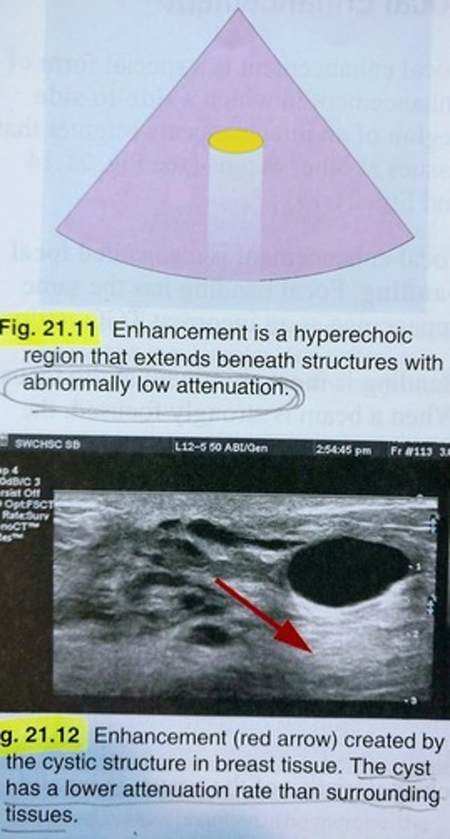 <p>d) weakly attenuating structures</p><p>ex) think of the bladder (attenuation rate is slower through fluid than SBT, so enhancement is seen posteriorly to bladder</p>