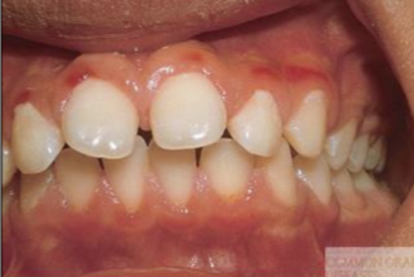 <p>red linear band at marginal gingiva</p><p>- spontaneous bleeding &amp; petechiae may be present</p><p>does NOT respond to improved OH</p>